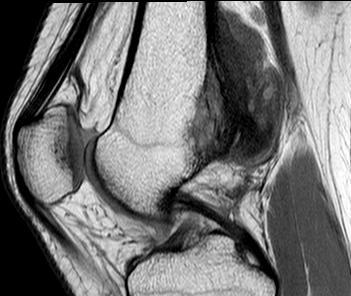 Parosteal Osteosarcoma MRI0002